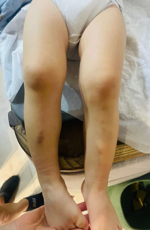 Kreşte Şiddet İddiası: Çocuğunun Vücudunu Gören Anne, Savcılığa Koştu